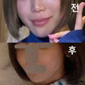 시술 전 실 개봉해서 보여주십니다! 시술 후 큰 멍 없었구 다운타임도 짧은 편인 것 같아요!!