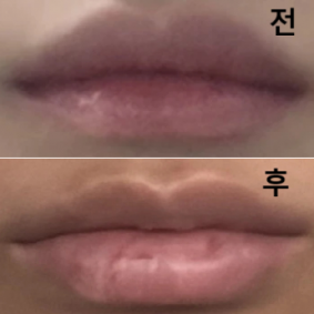 친구가 여기서 받고 온 모습을 보고 여기 병원이다! 라는 마음이 들어 방문했어요! 아직 2일차라 필러가 자리를 잡아야겠지만 지금은 정말 만족스러워용!!