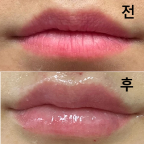 입술필러는 무조건 여기로 원픽 하겠습니다!!