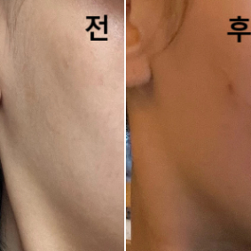 매번 필러 녹이러 롤리팝으로 방문해여!! 친절하십니다~!