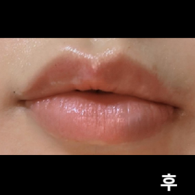 설명도 너무 자세히 해주시고 이런 곳은 처음인 것 같아요!! 첫 날이라 붓기가 빠져봐야 알겠지만 모양도 너무 맘에 듭니다!!!