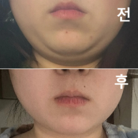 후기가 많아서 선탣했는데 병원 직원분들 넘 친절하시구 대기도 엄청 길지 않아 좋아써용~