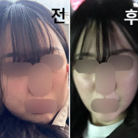 볼 살 때문에 2차 방문!! 효과 좋았어서 서울까지 가서 받았습니다 ㅋㅋ