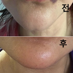 턱끝이 짧은 편이라 얼굴이 동글해보이고 여성스러운 느낌이 없었는데 턱끝 필러 한방으로 여성스러운 선을 가지게 된 것 같아요~