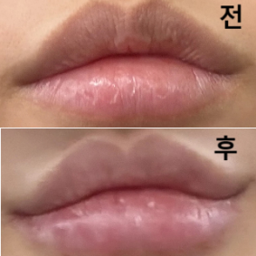 제 원하는 방향성 그대로 나오도록 시술 해 주셔서 만족 100 퍼센트 입니당!!