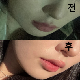 1번째 시술 후 효과가 괜찮았어서 2주 간격으로 두 번재 시술 받았습니다!!