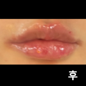 입술 비대칭이 심하고 볼륨이 없었는데 맞고 난 후 확실히 괜찮아졌어요!!