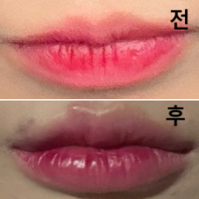 상담도 너무너무 자세하게 해주시고 시술도 딱 제가 원하는 고양이 입술 됐어요~~ 입술필러 이번이 3번짼데 여기 진짜 제일 만족합니다!! 최고!!