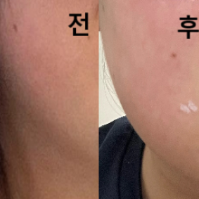 시술도 정말 금방 끝났는데 간호사분과 의사선생님께서도 하나하나 다 알려주시고 친절함의 끝판왕이셨습니다!!