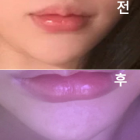 턱 뾰족해지구 싶어서 맞았는데 멍도 안들구 넘 좋아용!!