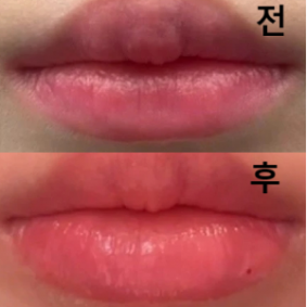 컴플렉스였던 아랫입술 비대칭 교정과 가운데 부분 살짝 볼륨 채우려고 한 건데 둘 다 완벽하게 해결됐습니다!!
