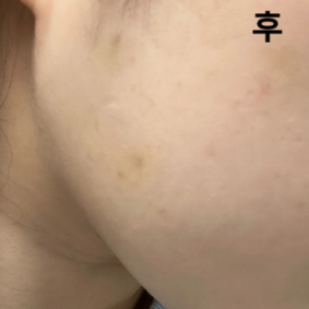 사각턱 보톡스는 처음이라 조금 걱정했는데 맞고나서 앙 했을 때 튀어나오는 것들 안 보이고 하루 지났는데 갸름해진게 보여요!!