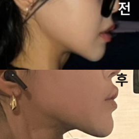 디자인 자체도 엄청 대만족스럽고 깔끔한 날렵한 턱과 팔자주름도 통통한 한국언니가 되었습니다^^