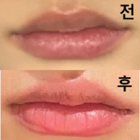 갑자기 자연스러운 입꼬리가 예뻐보여서 녹이러 갔는데 친절하게 잘 해주셨어요!!