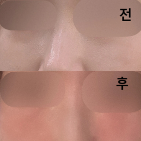 다른 곳에서 울트라콜 시술 받다가 롤리팝에서 맞았는데 여기 너무 잘하셔요!!