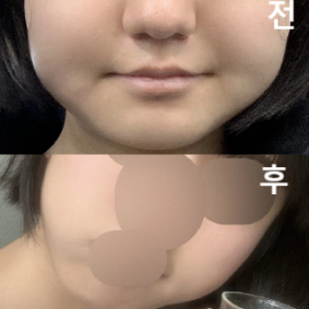 일주일 됐는데 확실히 얼굴 살이 빠져서 몸은 3키로 쪘는데도 살 뻐졌냐는 소리를 들었어용!!