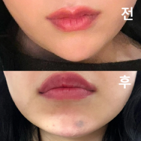 8년 전 받은 필러가 내려 앉아서 필러 녹이려고 방문했어요! 걱정했는데 친절하게 잘 해주셔서 만족하고 추천합니당~~!!