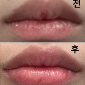 쪼오끔 따끔햇구요 비대칭이 좀 있어 원장님이 왼쪽에 더 넣어주셨어요~