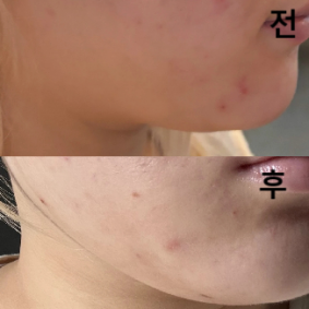 의사선생님이 엄청 친절하시고 덜 아프게 주사 놔주셔서 좋았어요!! 2+1 행사도 받았습니당~~