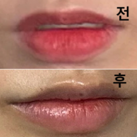 멍이 조금 들었지만, 원하는대로 시술 결과가 나와 만족합니다~