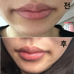 지방분해주사는 만족스러웠어요 !!