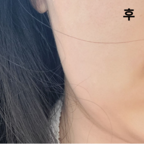 통증 크게 없고 용량 최대한으로 해주셔서 효과 좋아용~~