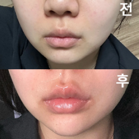 무턱이라 턱 필러 고민하고 있었는데 맞고 나니까 너무 좋아요!!