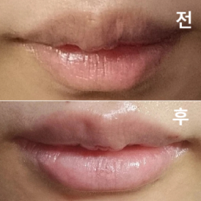 아직 붓기가 빠져봐야 알겠지만 만족스럽습니다!!