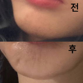 다른 시술이랑 같이 보톡스 했는데 다른데서 했던 것보다 잘 됐어요! 효과 빠르고 너무 맘에 들어요~
