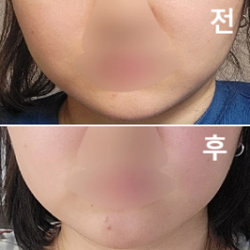 2번째 포키주사여서 확실히 효과가 1차 때보다 눈에 보여서 좋습니다!!