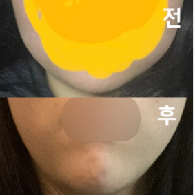 첨에 엄청 부어서 깜짝 놀랐지만 서서히 없어지면서 더 갸름해지는 효과를 보게 될 수 있었습니당~!