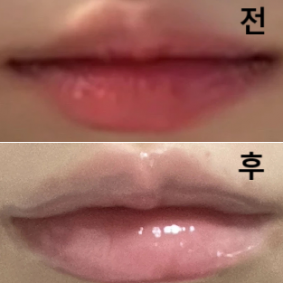 병원 인테리어도 예쁘고 시술 받을 때 제 의견 물어봐주시면서 안 아프게 잘 놔주셔써용~