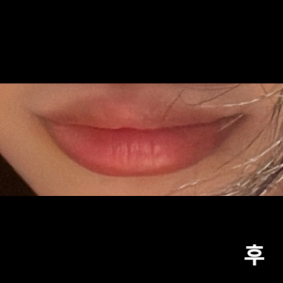 예전에 맞았던 곳보다 훨씬 필러 안 아프게 잘 놓아주시고 직원분들 엄청 친절하세여 앞으로 입술필러는 여기서만 맞으려구요 ㅎㅎ 감사합니당~