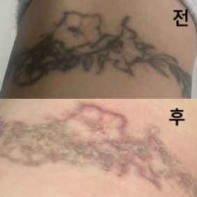 시술 후 키트도 잘 챙겨주시고 잘 지워지고 있는 것 같아요~~