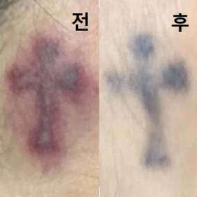 여러번 지웠는데 드디어 조금씩 흐려지기 시작했네요 ㅠ 감사합니다!!