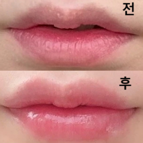 처음 맞았을 때 아랫입술 볼륨이 약한게 불만이었다고 말씀 드리니까 그 부분 보완해서 놔주셨어용 ㅎㅎ