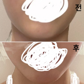 너무 잘 해주시고 시술 받은 동안 의사선생님께서 좋은 말도 많이 해주셔서 좋은 시간 보내고 왔어요!