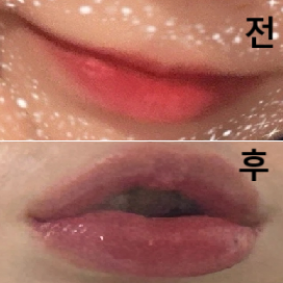 다른 곳에서 입술 필러 받았을 때 효과가 만족스럽지 않아서 고민했는데 롤리팝에서는 효과가 눈에 띄게 보여서 만족했습니당!!