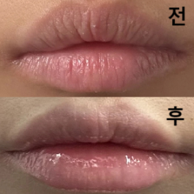 이벤트로 싸게 해서 만족스럽습니당! 실장님이 사진 보여주시면서 자세하게 상담해주셨구 의사선생님도 꼼꼼하게 시술 해주셨어여!!