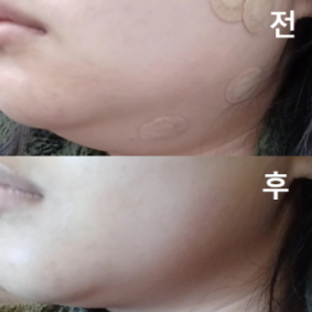 시술 상담도 친절하게 진행되었고 대기도 짧아서 충분히 만족했습니당!