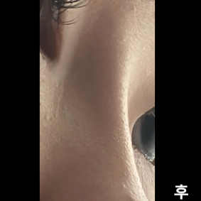 실리프팅 하고 좀 더 욕심이 생겨서 한 건데 진짜 대성공! 없었던 콧대를 찾음 추천띠~~