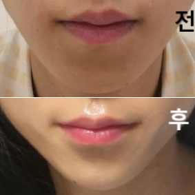 아프지 않게 잘 놔주셨고 효과도 만족해여!!