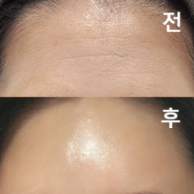 미간 이마 시술 받았고 많이 아프지 않아서 만족합니다!