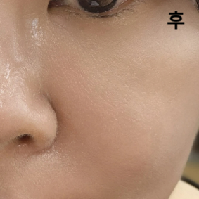 통증도 없고 시간 지나야 채워지는 콜라겐 재생 부스터인만큼 효과가 좋기를 기대합니다!