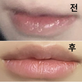 딱 주름 펴질 정도 플럼퍼 바른 정도로 도톰해지길 원했는데 너무 자연스럽게 잘 해주셔서 감사합니다~~