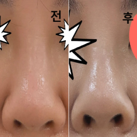 붓기나 통증 없고 자연스럽게 잘 돼서 너무 만족합니다!!!