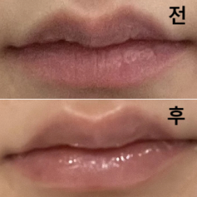 선생님께서 밸런스를 보면서 시술해주셨어요~!