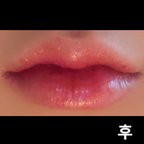 시술 직후부터 2-3일 까지는 붓기가 있어서 시술 받은 티가 나 신경쓰일 수 있으나 붓기가 가라앉으면 티 안나고 예쁜 입술 보시고 만족하실수 있을거예요!