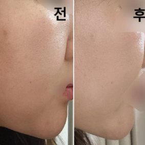 뭉쳐있던 흉살이 말랑해진 게 느껴졌어요~