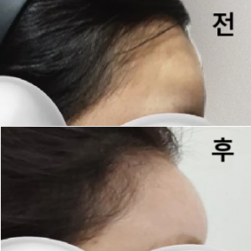 스탭, 선생님들 모두 착하시고 시술에대해서도 여러번 확인할 수 있어 안심하고 시술 받을 수 있었습니다!!